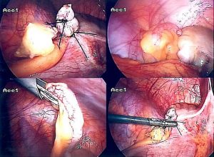 Appendix Entfernung