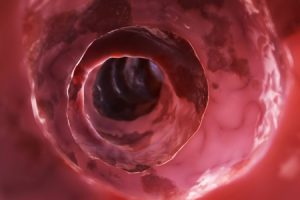 Inside of an unhealthy colon