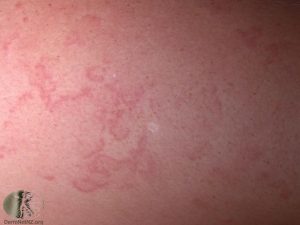 Erythema Marginatum photo