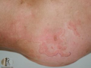 Erythema Marginatum picture