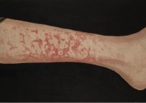 Erythema Marginatum on leg