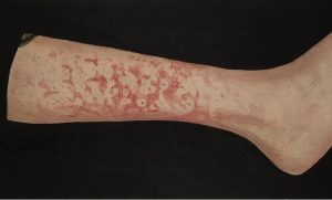 Erythema Marginatum picture on leg