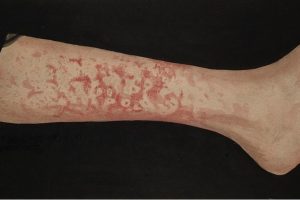 Erythema Marginatum on leg