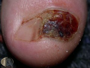 Subungual Melanoma in nail picture