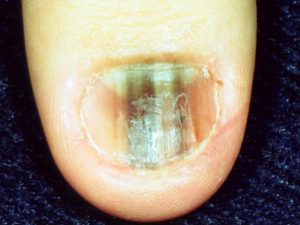 Subungual Melanoma in nail image