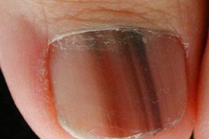nail melanoma photo