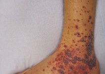 Petechiae on the low limb