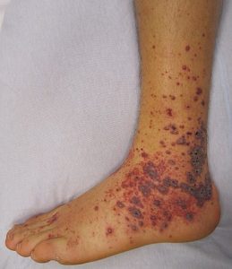 Petechiae on the low limb