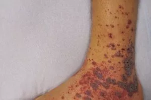 Petechiae on the low limb