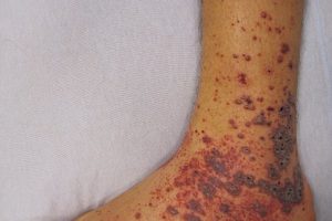 Petechiae on the low limb