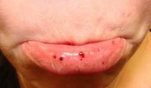Oral petechiae purpura on lower lip