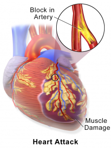 Heart Attack muscle damage