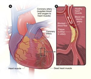 Massive heart attack illustration