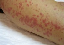 Maculopapular Rash on hand