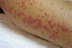 Maculopapular Rash on hand