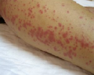 Maculopapular Rash photo on hand