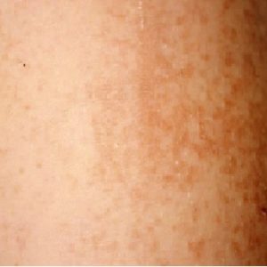 Maculopapular Rash picture