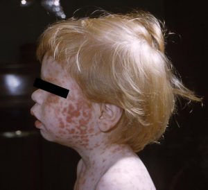 Maculopapular Rash photo on boy's face