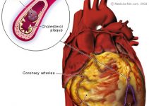 Heart attack anatomy