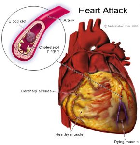 Massive Heart Attack anatomy