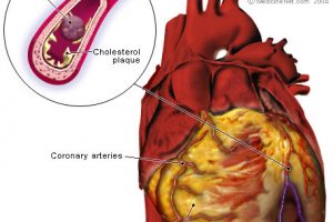 Heart attack anatomy