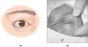 Trichiasis Ingrown Eyelash