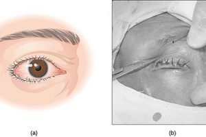 Trichiasis Ingrown Eyelash