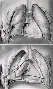 Tracheal Deviation image