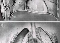 tracheal deviation Image