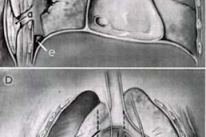 tracheal deviation Image