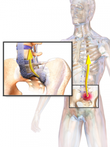 Ankylosing Spondylitis image