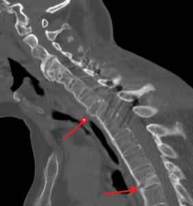 Two Spinal Fractures Ank Spondylitis