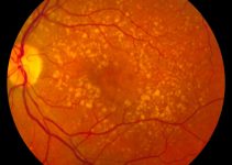 Intermediate age related macular degeneration