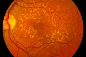 Intermediate age related macular degeneration