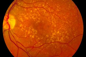 Intermediate age related macular degeneration