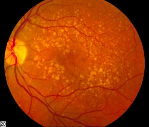 Intermediate age related macular degeneration