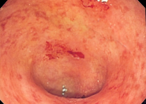 ulcerative colitis