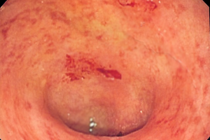 ulcerative colitis