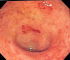 ulcerative colitis