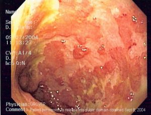 Ulcerative Colitis image